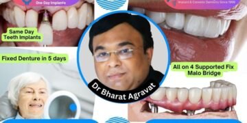 Best Dentist for Full Mouth Dental Implants Clinic in Ahmedabad: Dr. Bharat Agravat, the top Implantologist