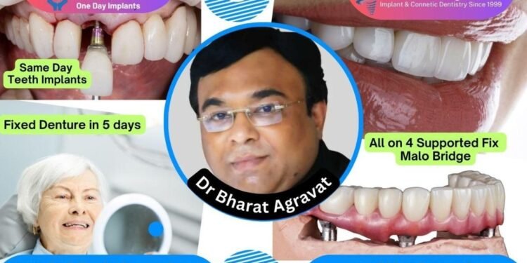 Best Dentist for Full Mouth Dental Implants Clinic in Ahmedabad: Dr. Bharat Agravat, the top Implantologist