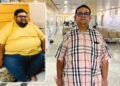 NOBESITY Surgery Helps Ahmedabad Resident Lose 109 Kg, Transforming Health and Life