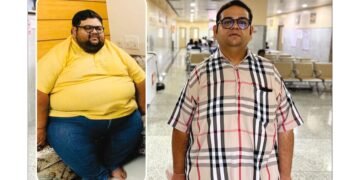 NOBESITY Surgery Helps Ahmedabad Resident Lose 109 Kg, Transforming Health and Life