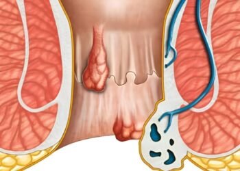 Doctors Found an Anal Fistula: Do I Need Surgery? Dr. Raviram S. Answers Your Questions!