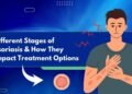 Different Stages of Psoriasis and How They Impact Treatment Options