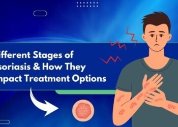 Different Stages of Psoriasis and How They Impact Treatment Options