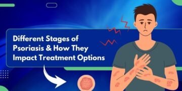 Different Stages of Psoriasis and How They Impact Treatment Options