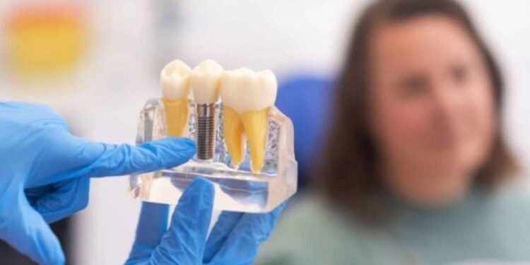 Dental Implants Can Slow Down Your Ageing