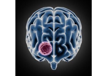 Sakra performs landmark surgery on 10×9 cm giant meningioma for 34-year-old Ghanaian patient
