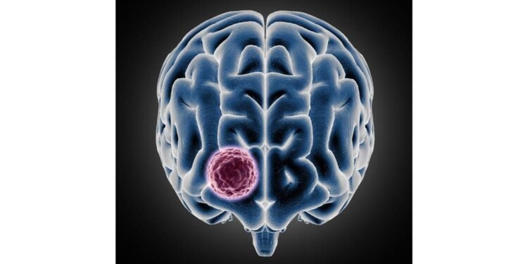 Sakra performs landmark surgery on 10×9 cm giant meningioma for 34-year-old Ghanaian patient