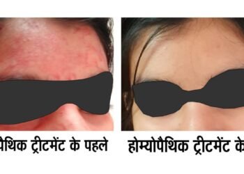 Rare disease Blood-Sweating Disorder Successfully Treated with Advanced Homeopathy – Dr AK dwivedi