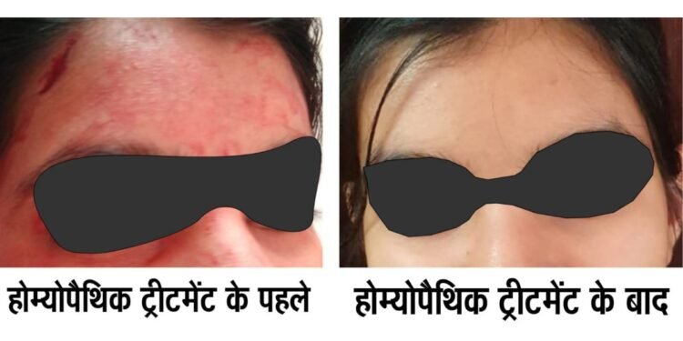 Rare disease Blood-Sweating Disorder Successfully Treated with Advanced Homeopathy – Dr AK dwivedi