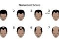 What is Causing Your Hair Fall? Take This Scientifically Backed Hair Loss Quiz