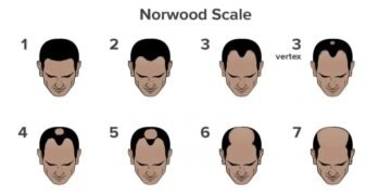 What is Causing Your Hair Fall? Take This Scientifically Backed Hair Loss Quiz