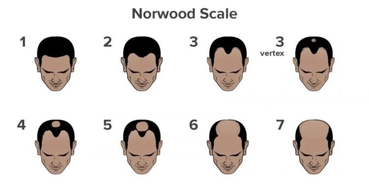 What is Causing Your Hair Fall? Take This Scientifically Backed Hair Loss Quiz
