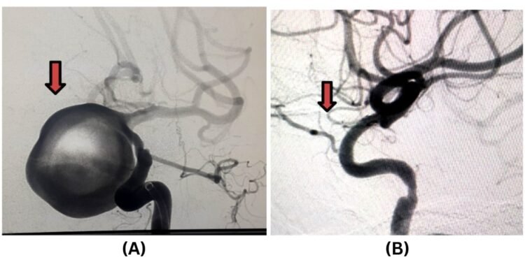 Pioneering Neurointerventional Excellence at Jehangir Hospital