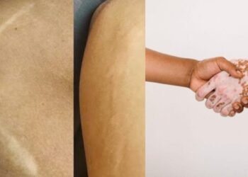 Scar and Vitiligo Treatment in Mumbai, Vitiligo and Scar Treatment Clinic in Mumbai – BrowMaster