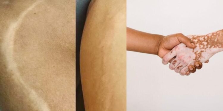 Scar and Vitiligo Treatment in Mumbai, Vitiligo and Scar Treatment Clinic in Mumbai – BrowMaster