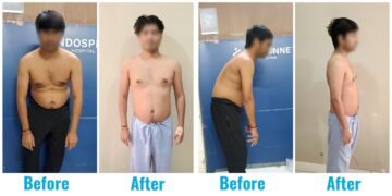 A 31-year-old who lived on a chair… until his spine finally said, ‘Enough’