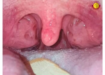 From Mama – Baba to Thank You Doctor : Dr. Purodha Prasad ENT Surgery Changes a Young Life in Delhi NCR