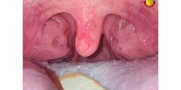 From Mama – Baba to Thank You Doctor : Dr. Purodha Prasad ENT Surgery Changes a Young Life in Delhi NCR