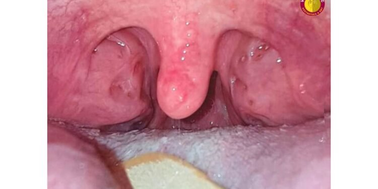 From Mama – Baba to Thank You Doctor : Dr. Purodha Prasad ENT Surgery Changes a Young Life in Delhi NCR