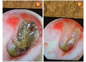 Cockroach in Ear: Dr. Purodha Prasad Saves Delhi Patient in Emergency ENT Case