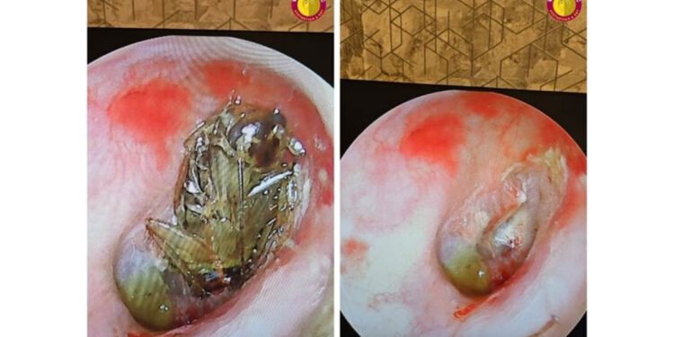 Cockroach in Ear: Dr. Purodha Prasad Saves Delhi Patient in Emergency ENT Case