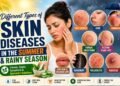 Different types of skin diseases in the Summer and Rainy Season