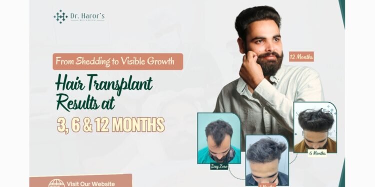 From Shedding to Visible Growth: Hair Transplant Results at 3, 6 and 12 Months
